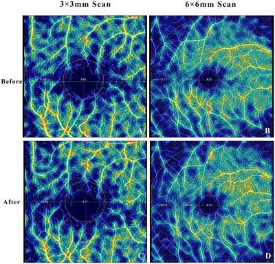 Effect of mydriasis on macular and peripapillary metrics in swept-source optical coherence tomography angiography